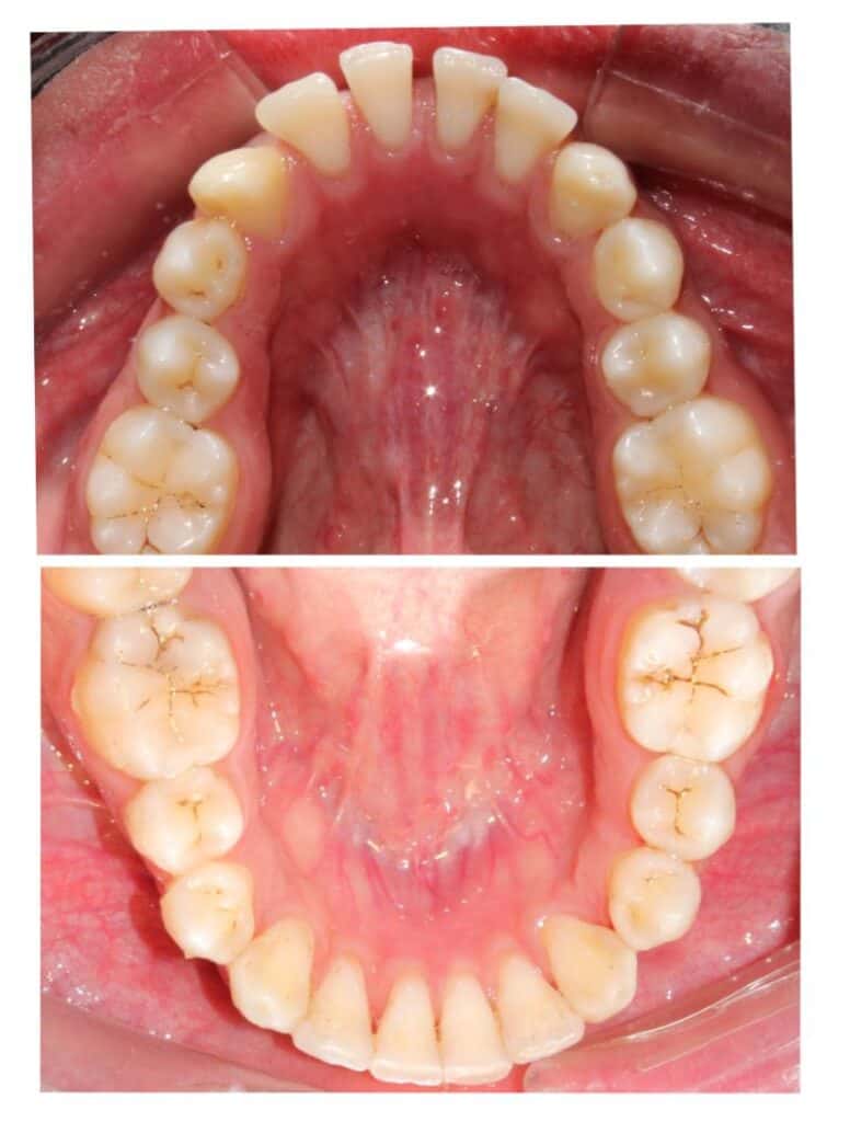 Upper dental arch with natural teeth – dental implants in Faisalabad