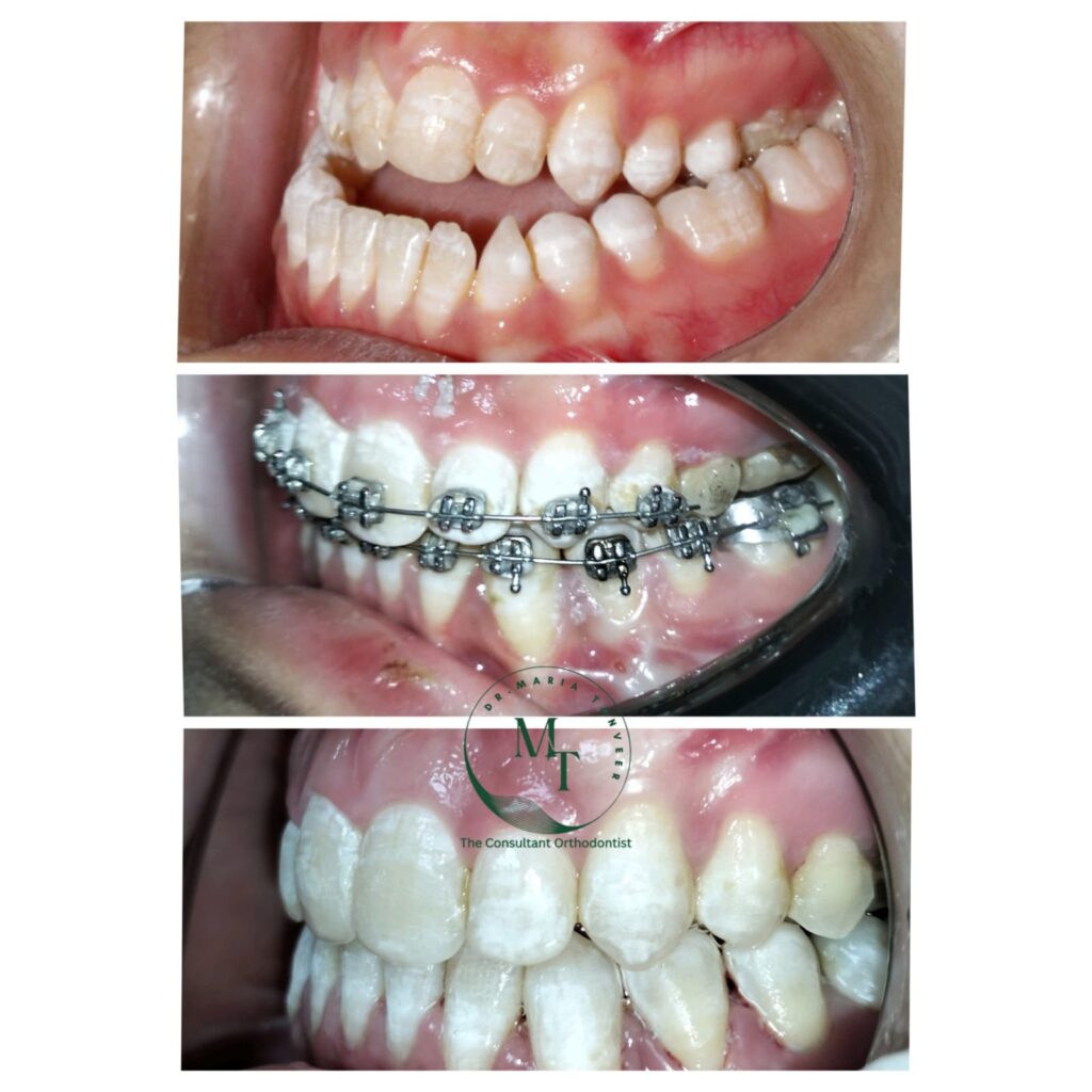 Three stages of combined orthodontics and jaw surgery treatment at Braces and Faces Faisalabad
