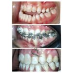 Three stages of combined orthodontics and jaw surgery treatment at Braces and Faces Faisalabad