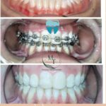 Three stage braces case closing front teeth gaps at Braces and Faces Faisalabad