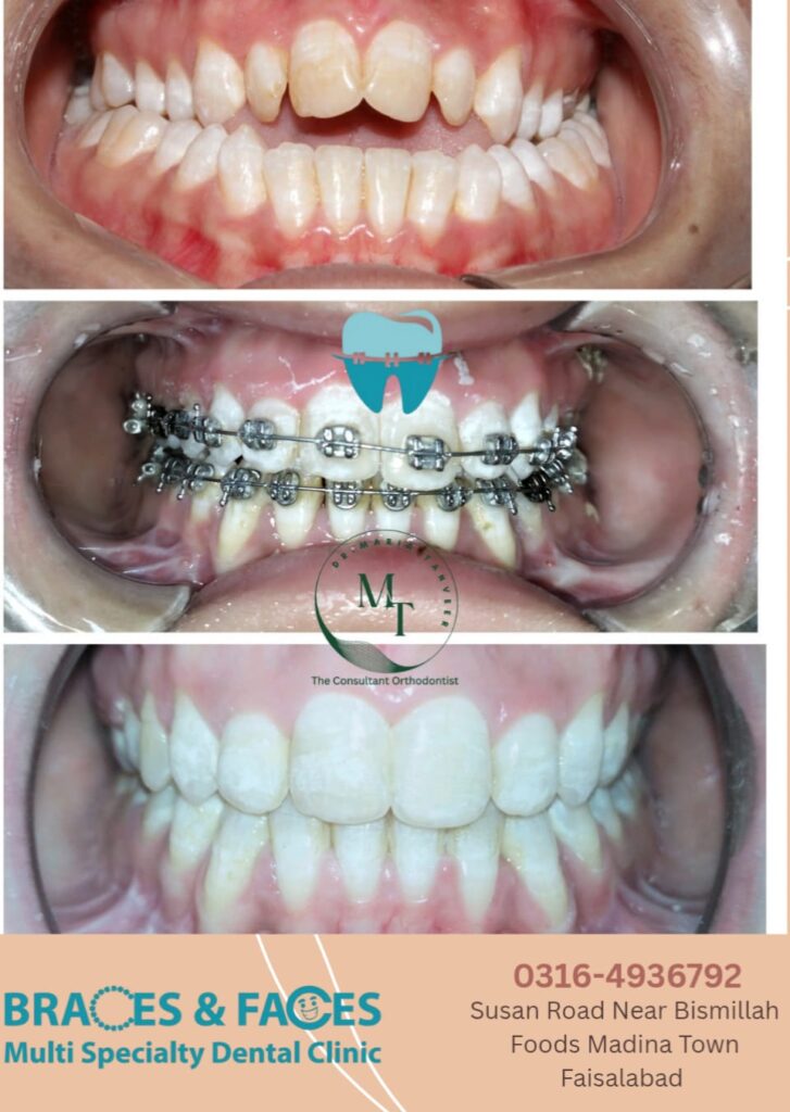 Three stage braces case closing front teeth gaps at Braces and Faces Faisalabad