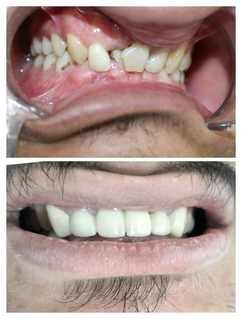 Crowded damaged upper front teeth before and restored smile after treatment at Braces and Faces Faisalabad