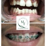 Uneven front teeth with gaps before braces and braces fitted with green ties at Braces and Faces Faisalabad