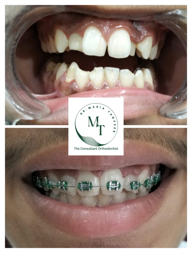 Uneven front teeth with gaps before braces and braces fitted with green ties at Braces and Faces Faisalabad