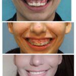 Smile before during and after gummy smile correction treatment at Braces and Faces Faisalabad