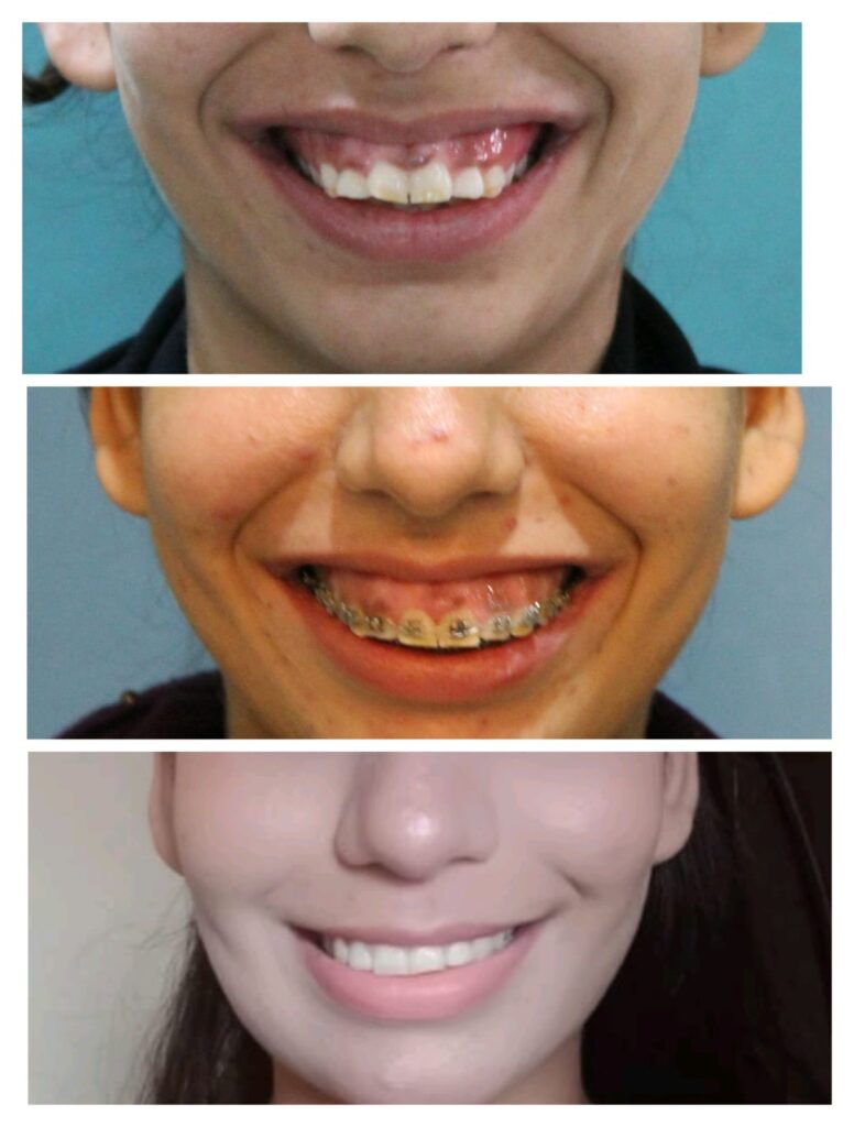 Smile before during and after gummy smile correction treatment at Braces and Faces Faisalabad