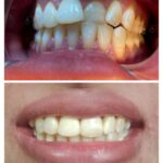Overlapping upper front teeth before treatment and even aligned smile after at Braces and Faces Faisalabad