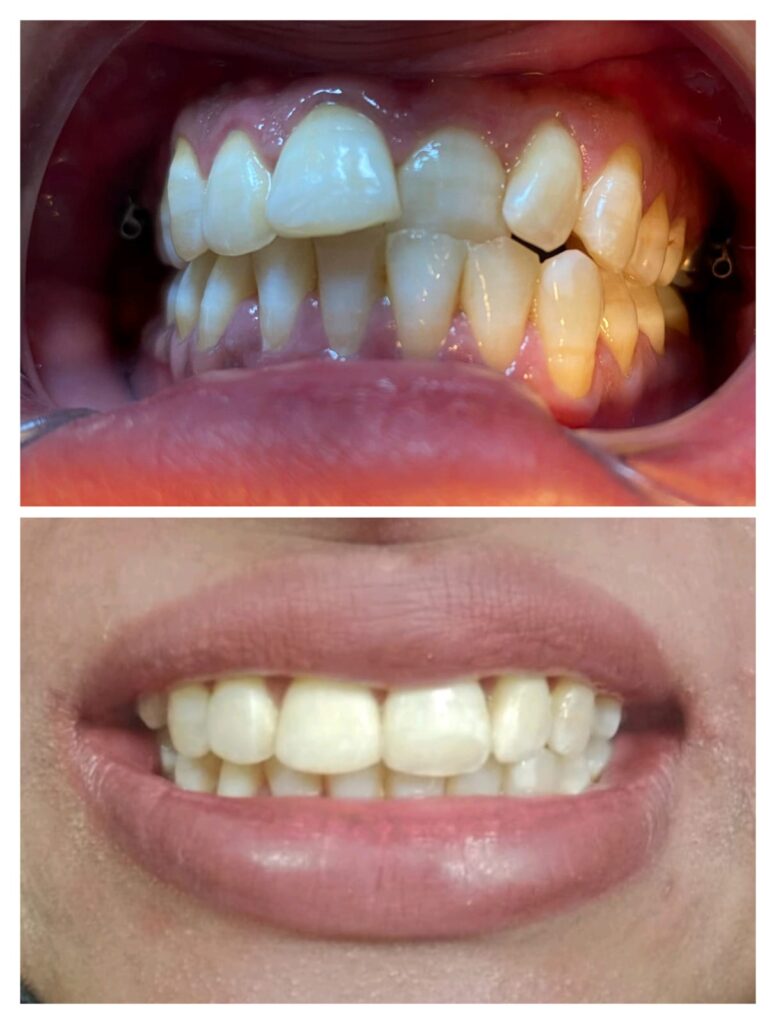 Overlapping upper front teeth before treatment and even aligned smile after at Braces and Faces Faisalabad