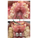 Upper dental arch before expansion and palatal expander appliance fitted at Braces and Faces Faisalabad
