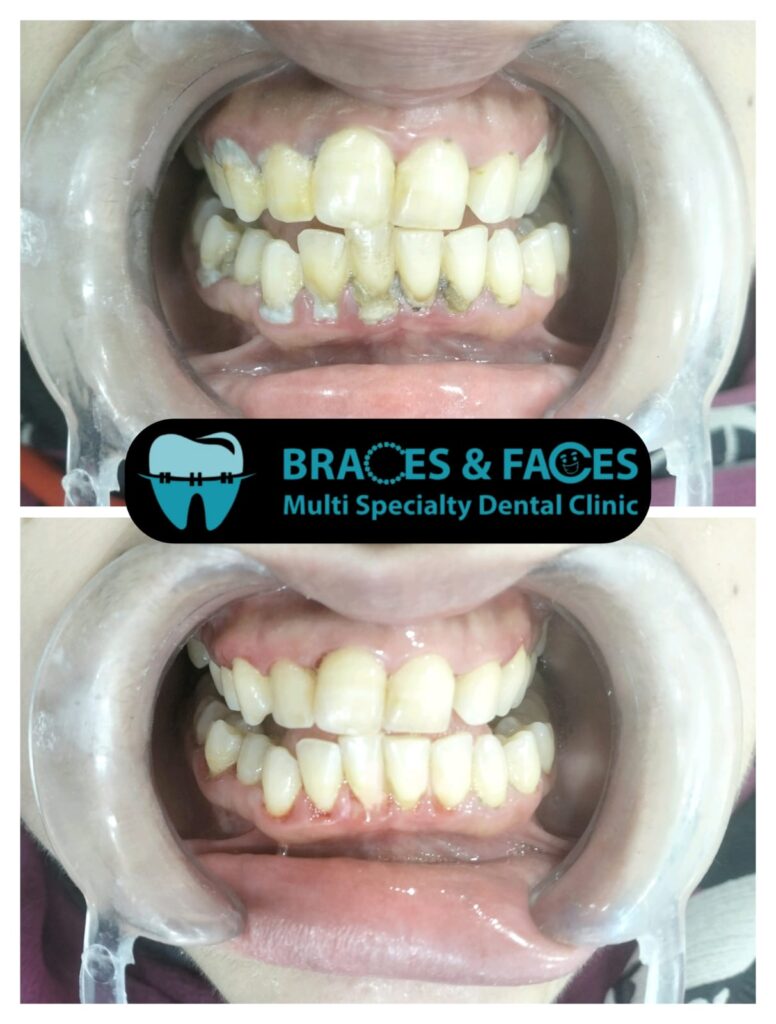 Teeth with heavy tartar buildup before professional scaling and polishing and clean teeth after at Braces and Faces Faisalabad