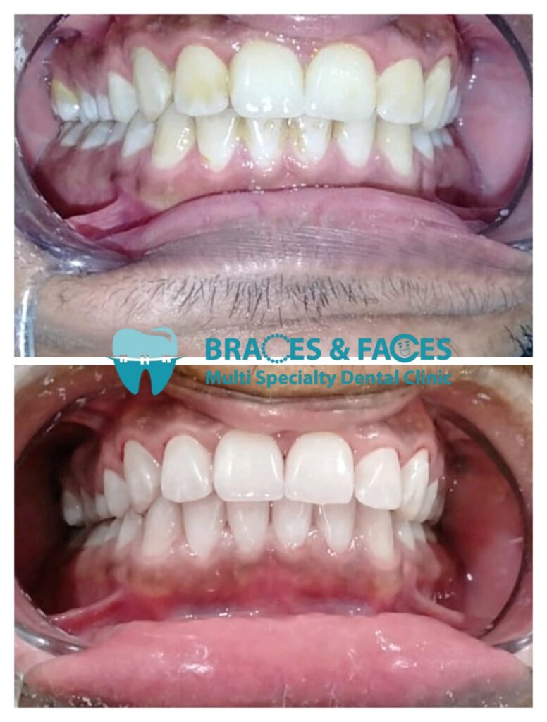 Uneven discoloured teeth before smile makeover and bright even smile after at Braces and Faces Faisalabad