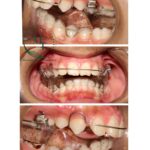 Twin block removable orthodontic appliance fitted in a young patient mouth at Braces and Faces Faisalabad