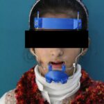 Child wearing a blue orthodontic facemask appliance for underbite correction at Braces and Faces Faisalabad