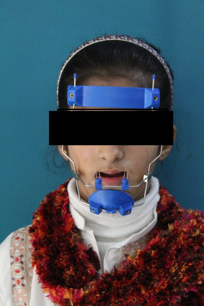 Child wearing a blue orthodontic facemask appliance for underbite correction at Braces and Faces Faisalabad