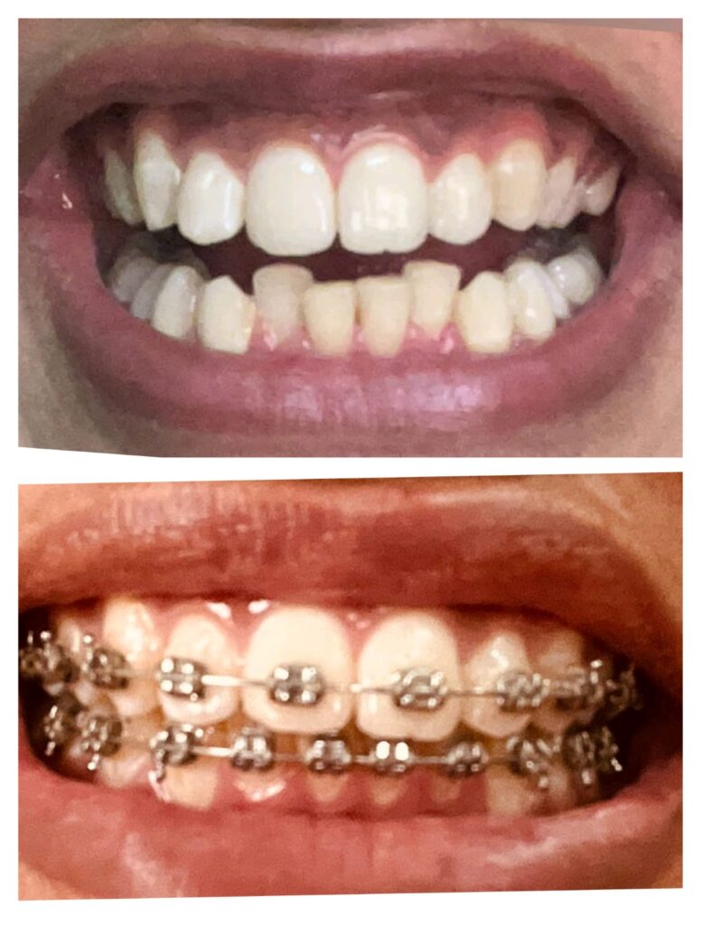 Uneven discoloured teeth before braces and bright even smile after treatment at Braces and Faces Faisalabad