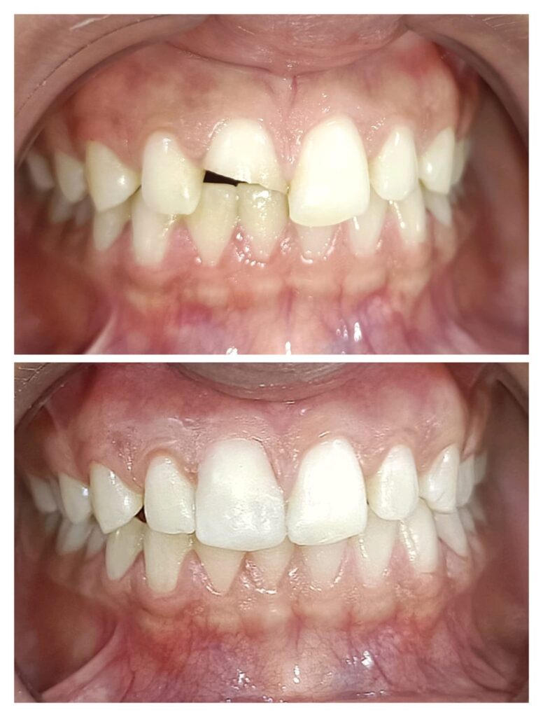 Fractured front tooth before repair and restored matching smile after at Braces and Faces Faisalabad