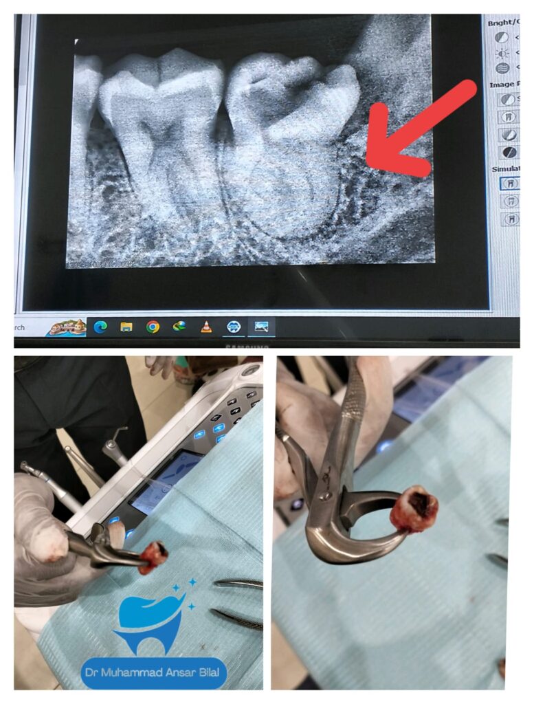 Dental X-ray showing impacted wisdom tooth and the extracted tooth held in forceps at Braces and Faces Faisalabad